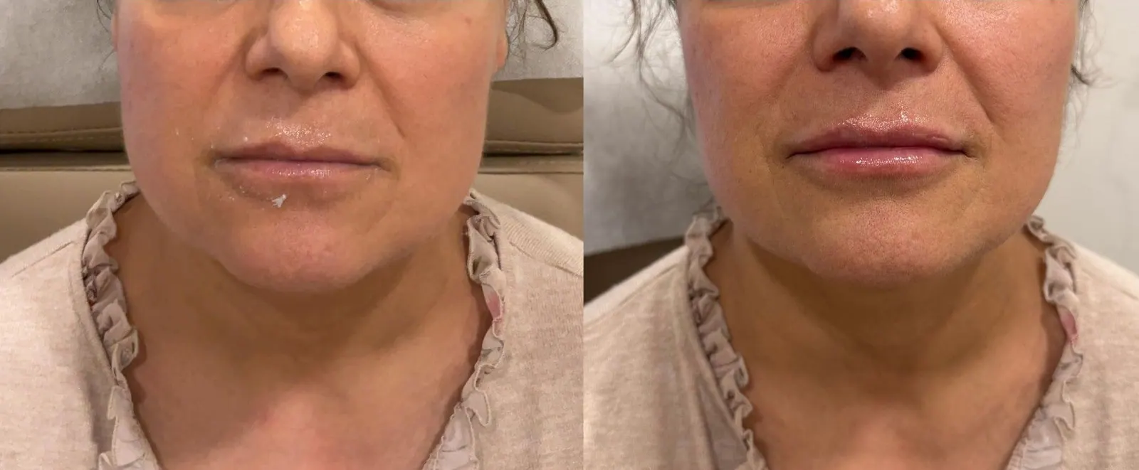 Lip Filler - Before & After